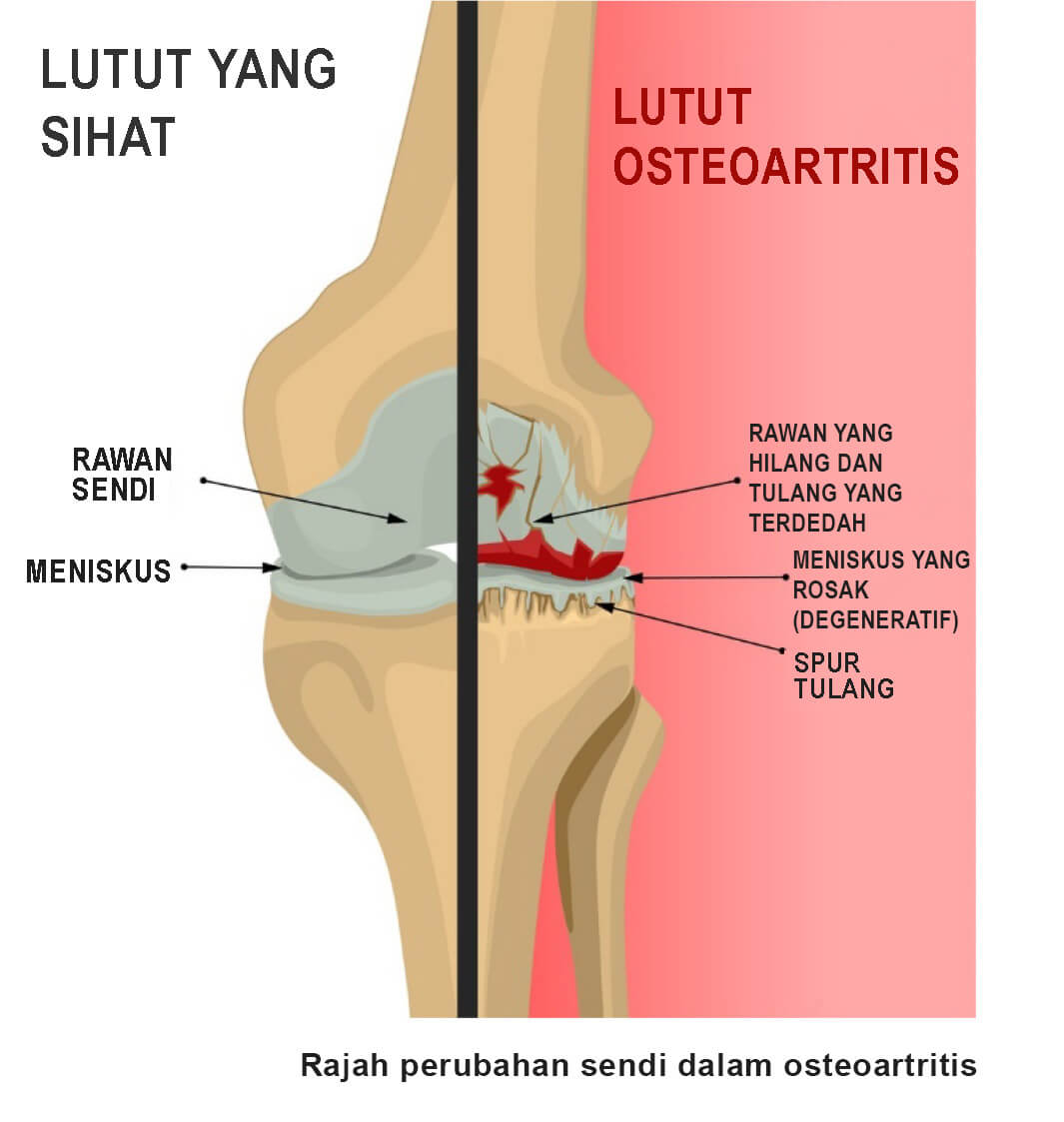 Osteoartirtis